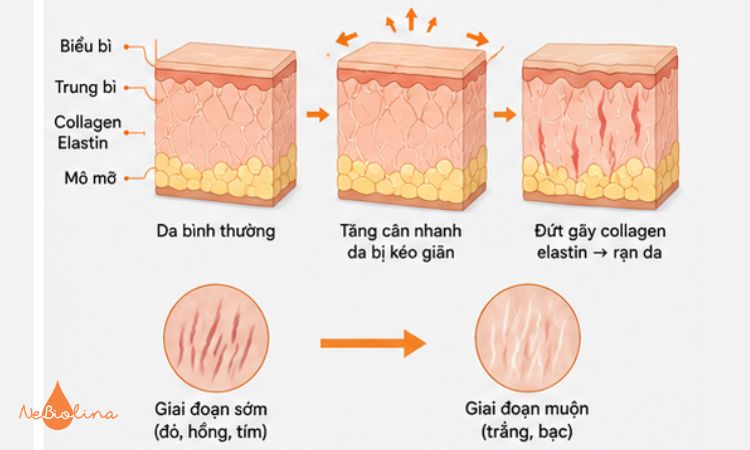 Cơ chế hình thành rạn da do tăng cân