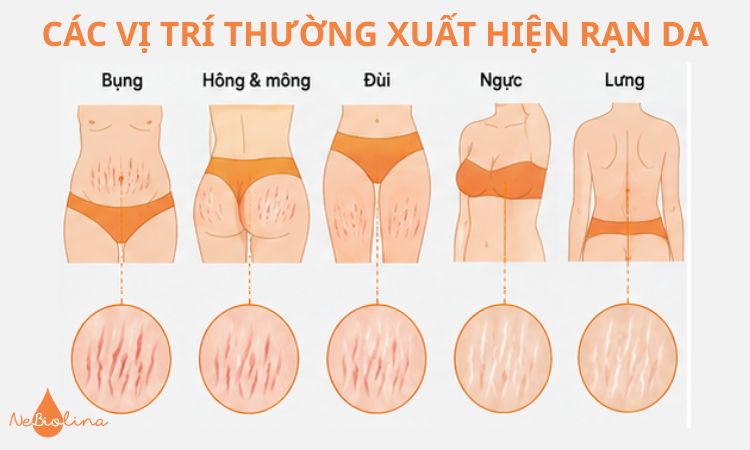 Những vị trí thường xuất hiện rạn da
