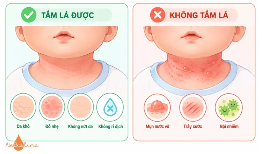 Không phải bé nào bị chàm sữa cũng có thể tắm lá. 