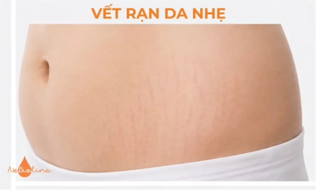 Rạn da nhẹ vùng bụng. 
