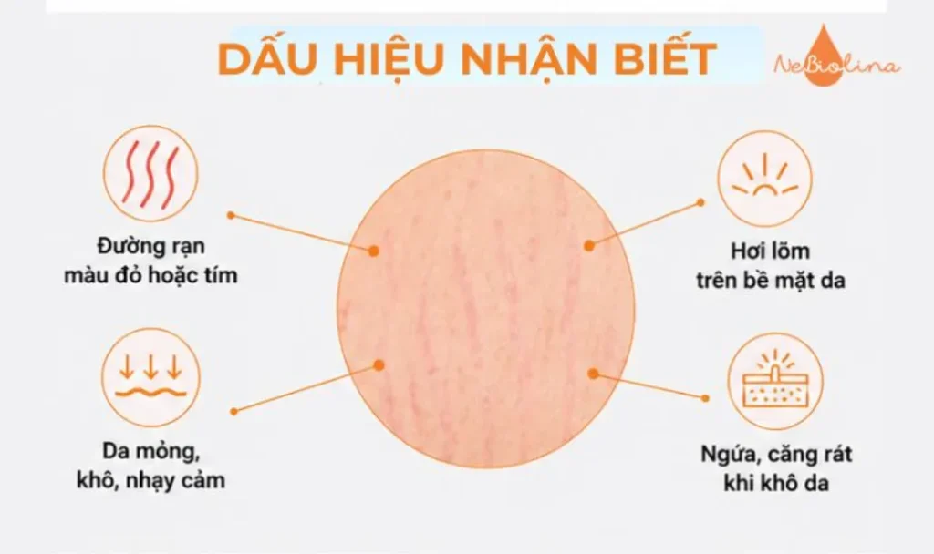 Dấu hiệu nhận biết rạn da. 