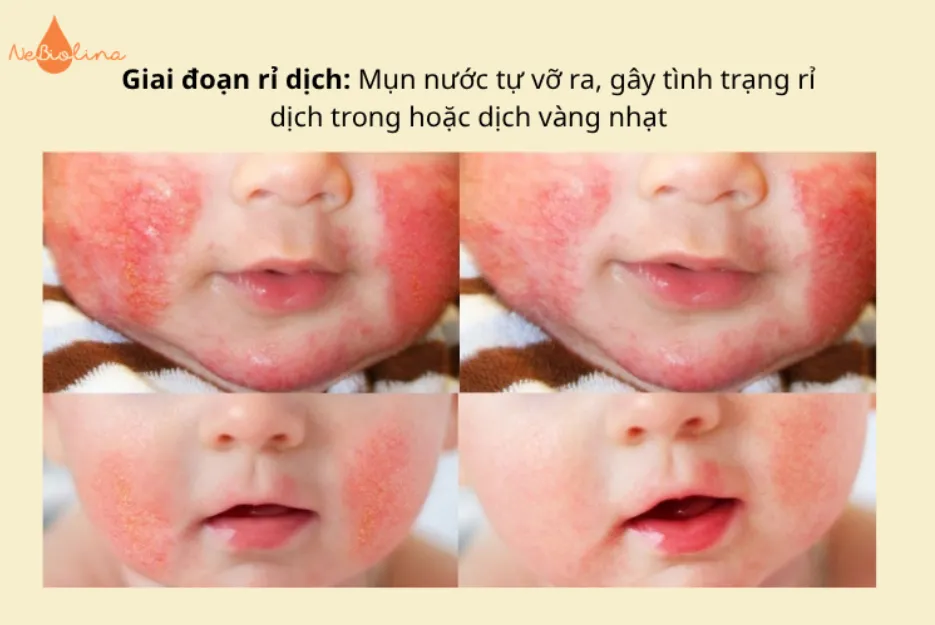 Giai đoạn rỉ dịch
