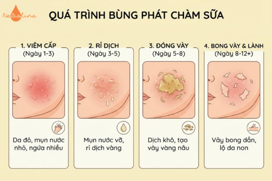 Quá trình bùng phát chàm sữa