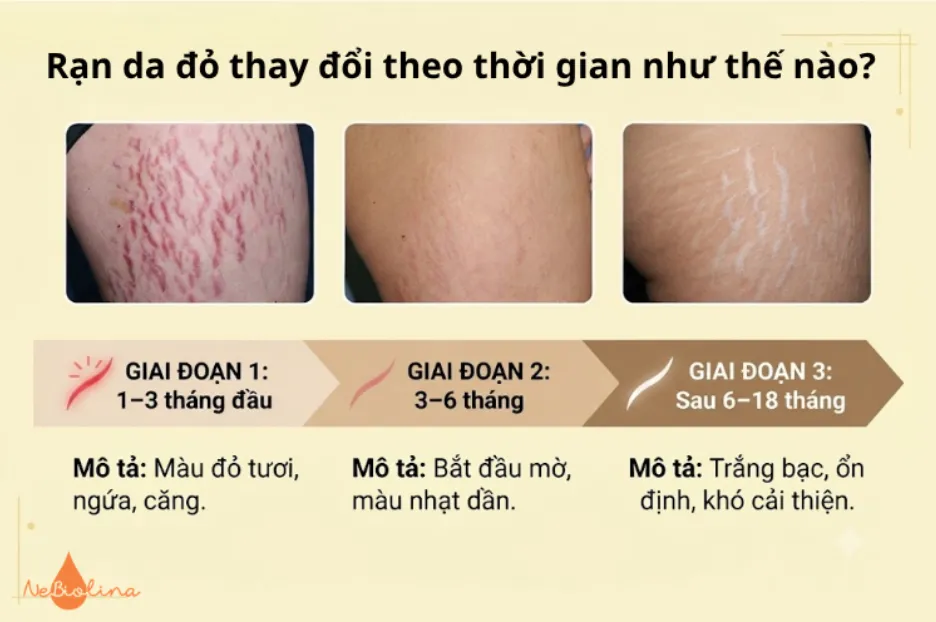 Rạn da đỏ thay đổi theo thời gian như thế nào?