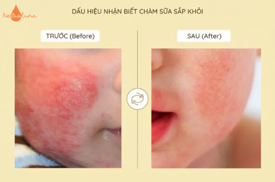 Dấu hiệu nhận biết chàm sữa sắp khỏi