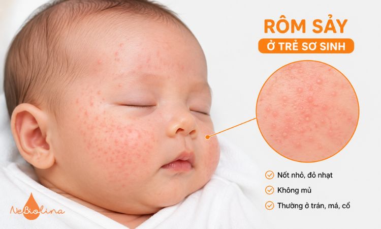 Rôm sảy ở trẻ sơ sinh