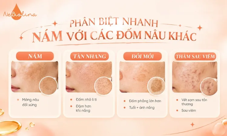 Một số tình trạng tăng sắc tố da dễ nhầm lẫn với nám