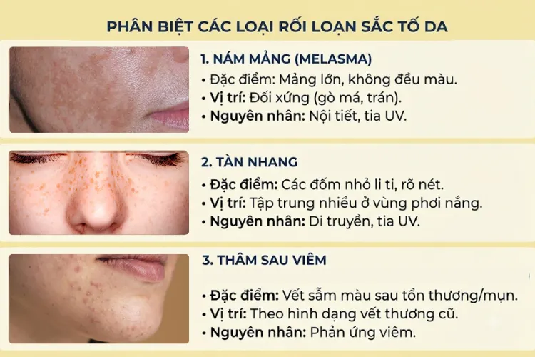 Phân biệt các loại rối loạn sắc tố da