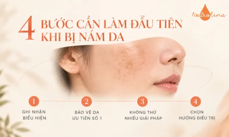 4 bước cần làm khi bị nám da