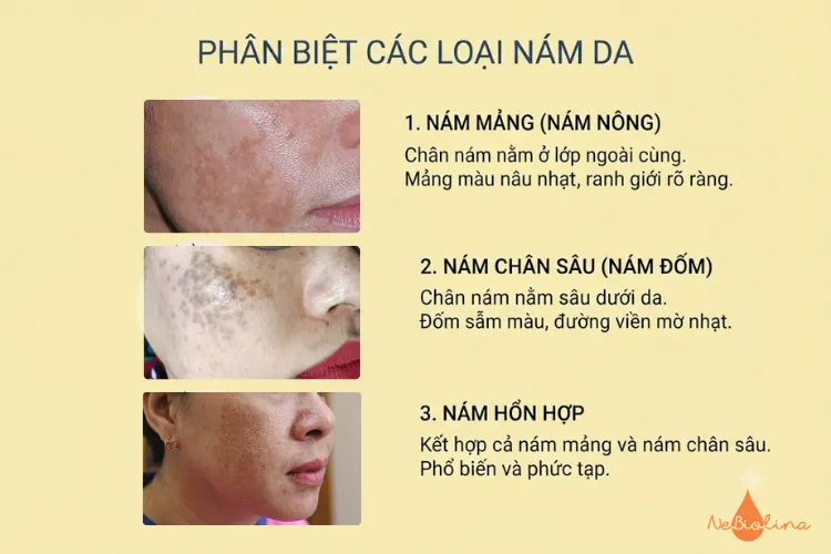 Phân biệt các loại nám da
