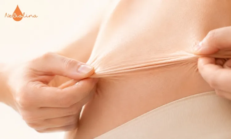 Rạn da xảy ra khi tốc độ giãn da vượt quá giới hạn phục hồi tự nhiên