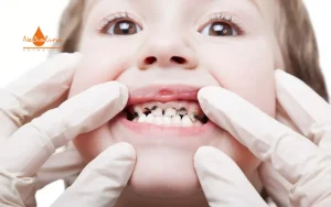 ảnh đại diện bài bé bị sâu răng sữa