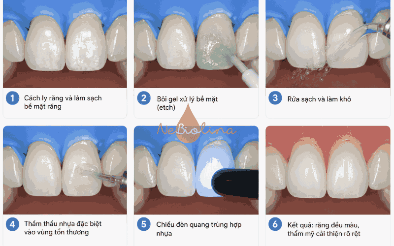 Quá trình Resin infiltration khử đốm trắng