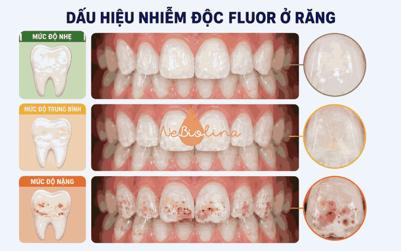 Dấu hiệu nhiễm độc fluor ở răng từ nhẹ tới nặng