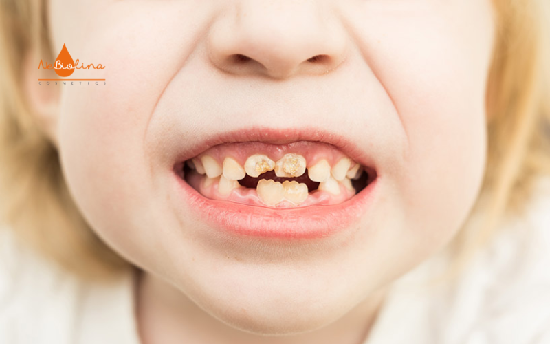 Nhiem doc fluor o tre