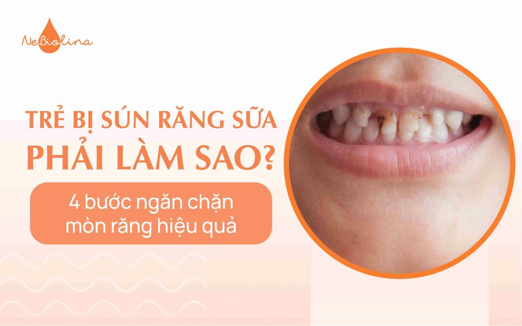 trẻ bị sún răng sữa phải làm sao