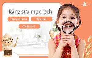 Răng sữa mọc lệch (1)
