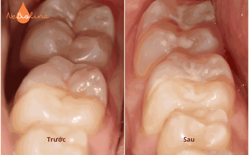 Trám răng sữa bị sâu bằng vật liệu composite 