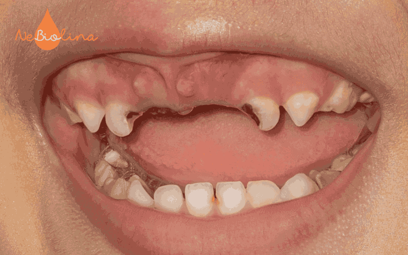 Răng sữa bị sâu đen