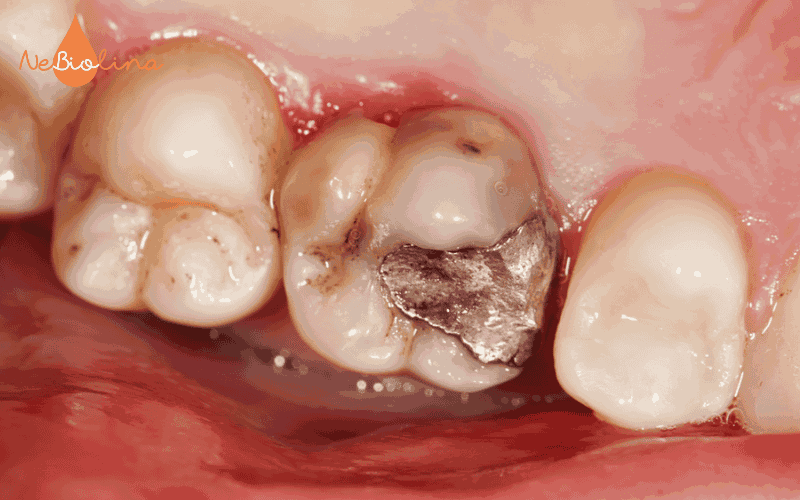 Trám răng sữa bị sâu bằng amalgam