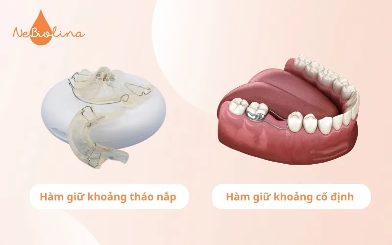 So sánh hàm giữ khoảng răng sữa cố định và tháo nắp
