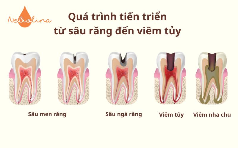 Quá trình tiến triển từ sâu răng đến viêm tủy