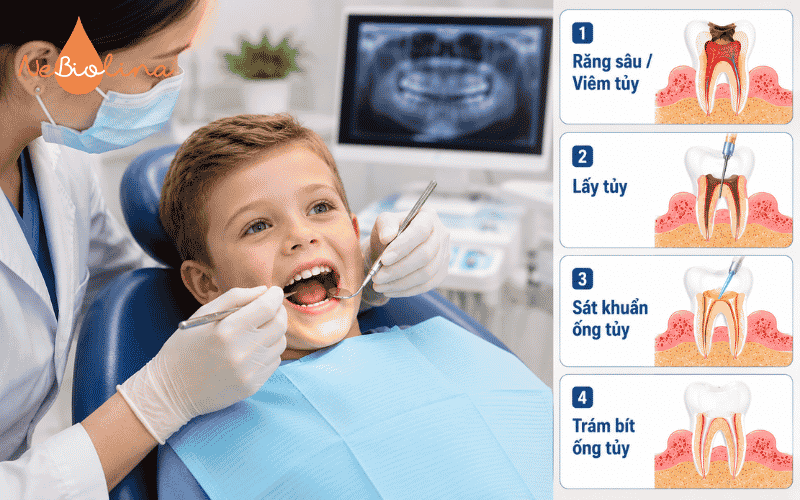 Quá trình lấy tủy toàn bộ cho răng sữa bị viêm tủy