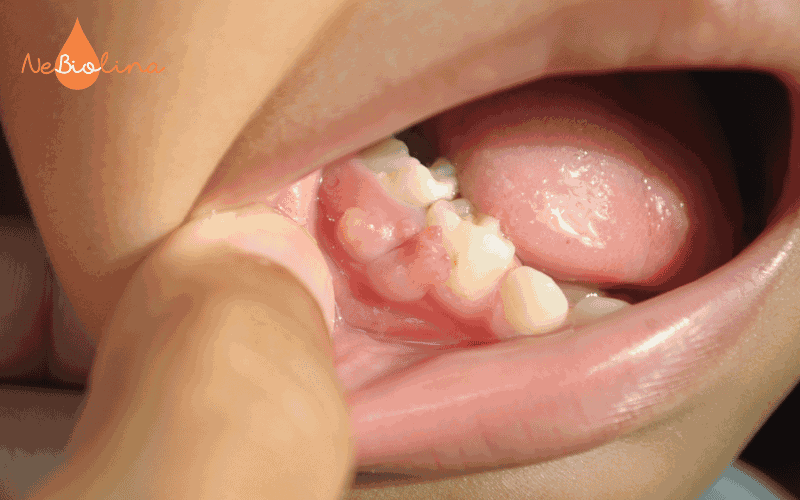 Trẻ bị sưng nướu sau điều trị tủy răng sữa