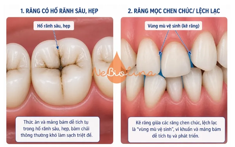 Răng chen chúc, hỗ rãnh sâu tăng nguy cơ sâu răng