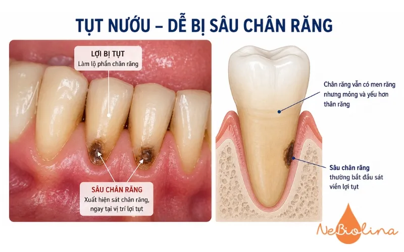 Tụt nước gây sâu răng ở người lớn tuổi