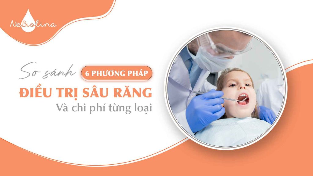So sánh 6 phương pháp điều trị sâu răng và chi phí từng loại (1)