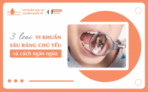 3 loại vi khuẩn sâu răng chủ yếu và cách ngăn ngừa. 