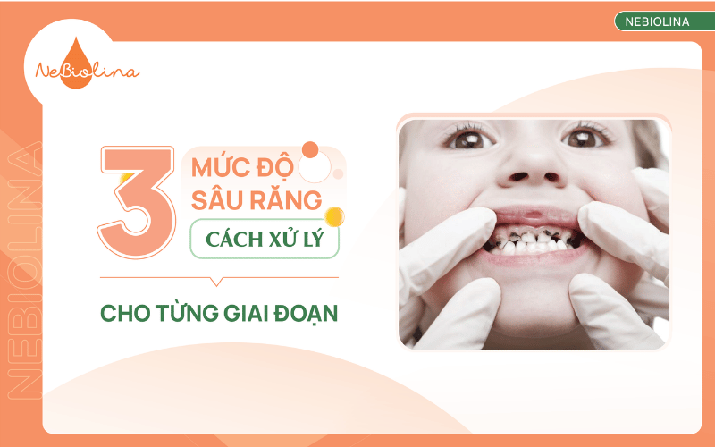 3 mức độ sâu răng và cách xử lý cho từng giai đoạn