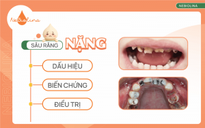 Sâu răng nặng