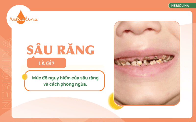 sâu răng là gì