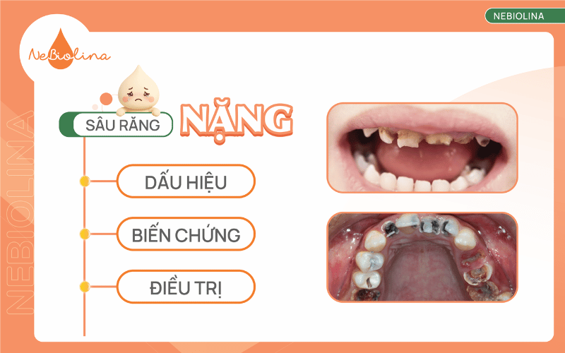 Sâu răng nặng
