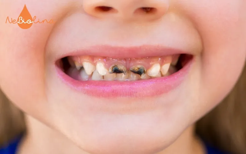 Trẻ nhỏ bị sâu răng cửa