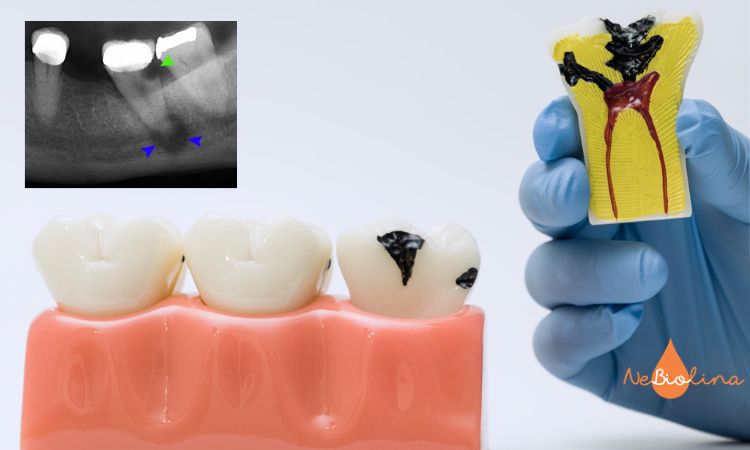 Sâu răng mức độ 3 có nguy cơ mất răng vĩnh viễn