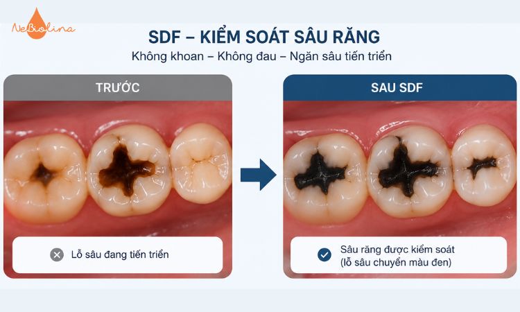 So sánh răng sâu trước và sau điều trị bằng SDF 