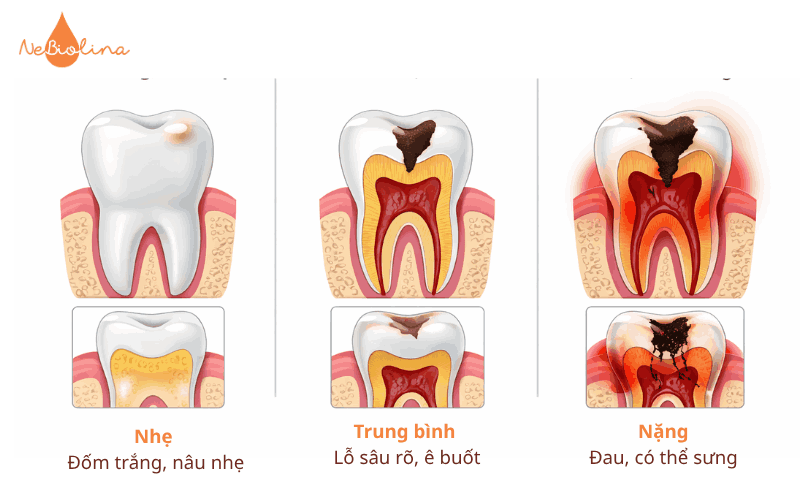 Dấu hiệu răng sữa bị sâu 