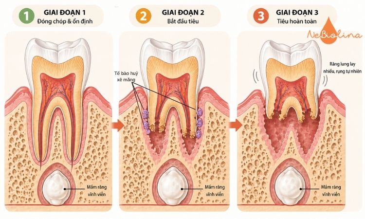 Quá trình tiêu chân răng sữa là hiện tượng sinh lý bình thường.