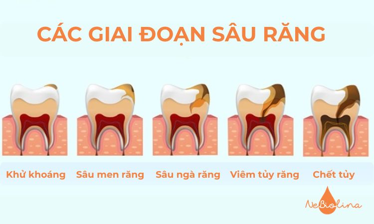 Các giai đoạn của sâu răng