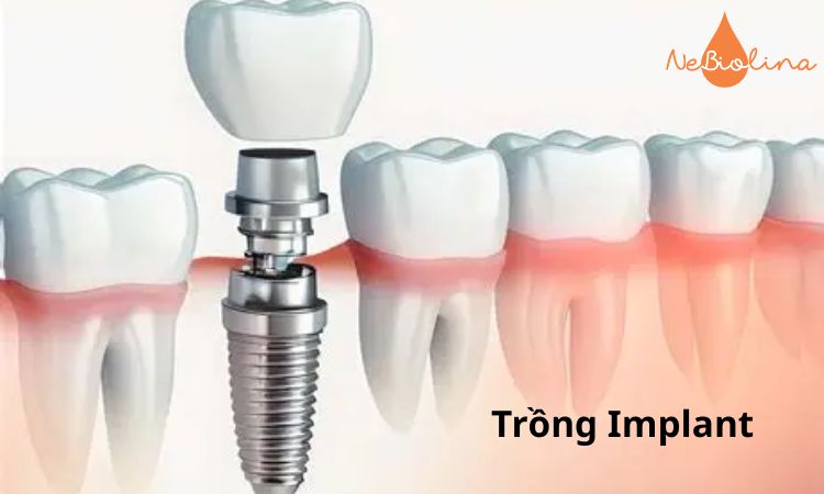 Trồng Implant giúp bảo toàn xương hàm.