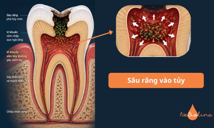 Vi khuẩn vào tủy gây viêm và đau dữ dội 