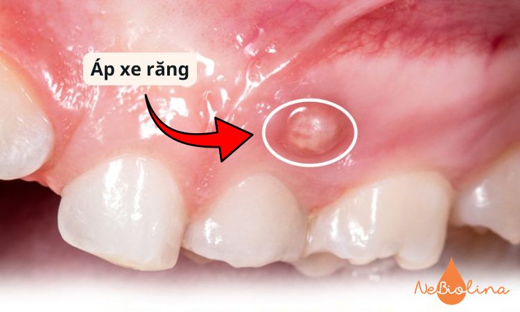 Không điều trị sâu răng kịp thời có thể gây áp xe răng.