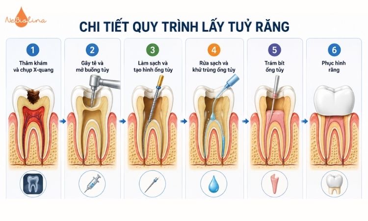 Quy trình lấy tủy răng