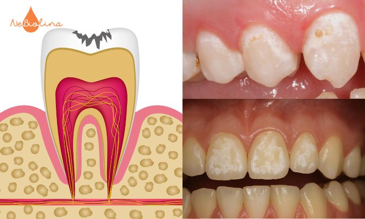 Sâu răng mức độ 1