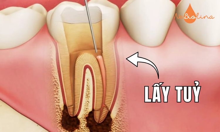 Lấy tủy được áp dụng khi bị sâu răng nặng.