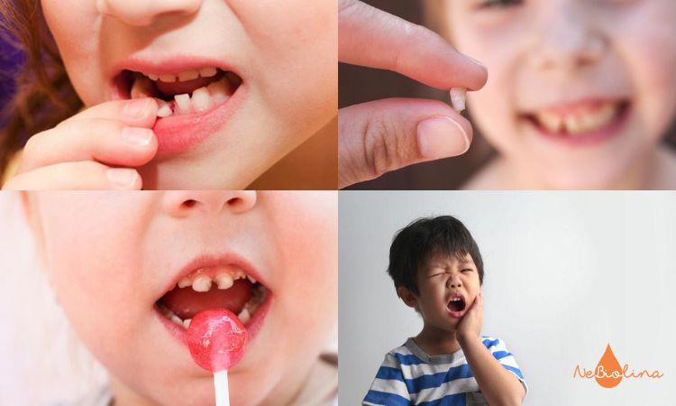 Sâu răng, lung lay hoặc gãy răng là một số vấn đề thường gặp ở trẻ