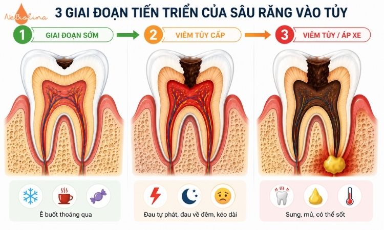 Diễn tiến sâu răng vào tuỷ theo 3 giai đoạn